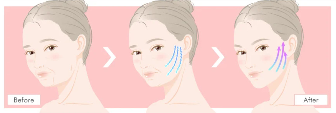 糸リフトは頬やフェイスラインのたるみやもたつき・ほうれい線やマリオネットラインといったシワの原因となっているたるみを根本的に改善させる治療法
