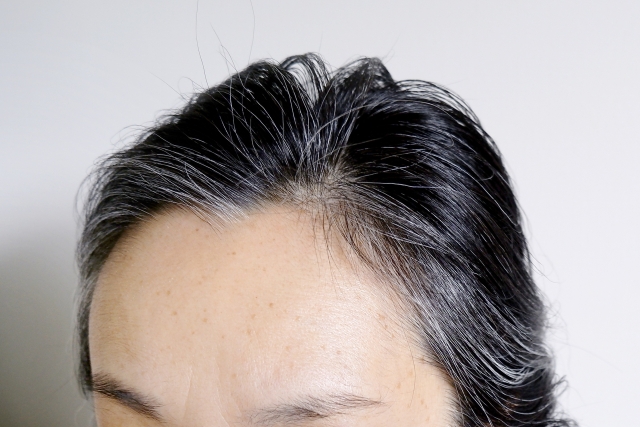 女性の薄毛（FAGA)｜原因と治療法