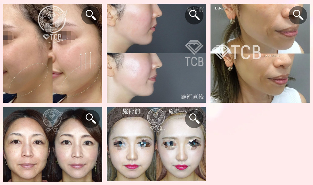 TCB東京中央美容外科のハイフ症例